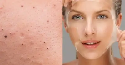 Tchau, cravos e espinhas: Peeling caseiro elimina tormento e dá pele de porcelana às 40+