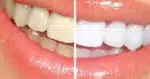 Dentes brancos com esses 5 alimentos (Foto: Montagem)