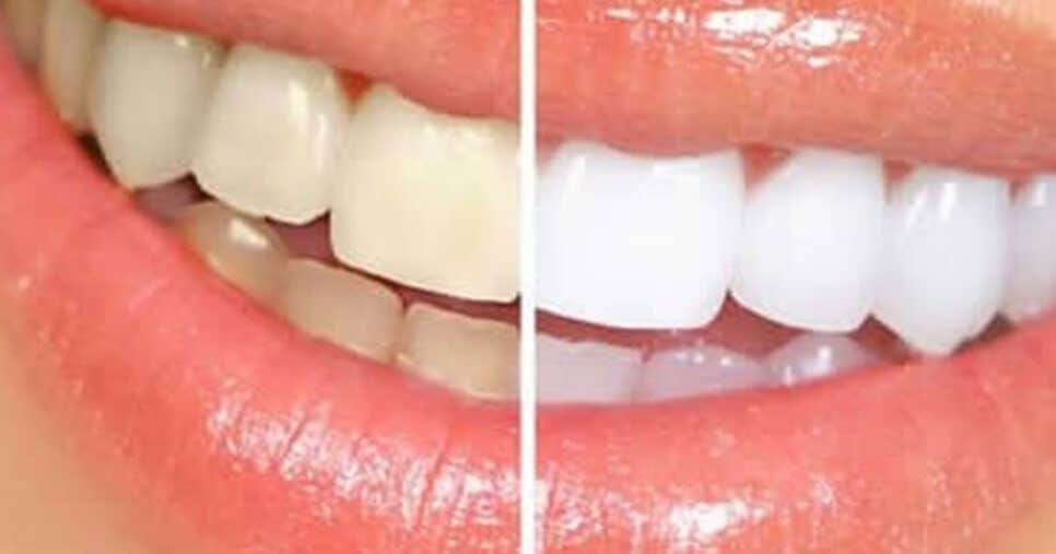 Dentes brancos com esses 5 alimentos (Foto: Montagem)