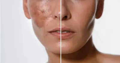 Pele lisinha eternamente: Mistura com 6 ingredientes dá fim as manchas na pele de idosas 60+