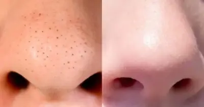 Limpeza de pele sem gastar 1 real: Receitinha caseira com 2 ingredientes dá fim aos cravos do nariz