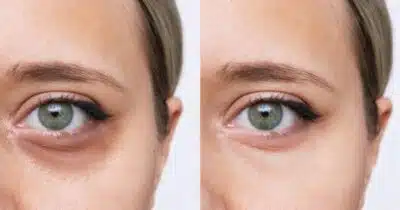 2 receitas milagrosas com ingredientes populares dão fim as olheiras - (Montagem / TV FOCO)