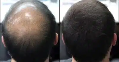 Homem, calvície antes e depois (Foto: Reprodução/ Internet)