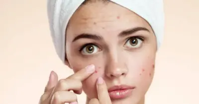 Fim da oleosidade, espinhas e rugas: Mistura natural com mel e +1 ingrediente traz pele de algodão as 30+