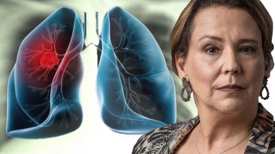 5 sinais do câncer de pulmão igual da atriz (Foto: Reprodução/ Internet/ Montagem)