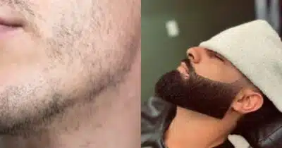 Mistura com 2 ingredientes dá fim as falhas na barba - Foto: Internet