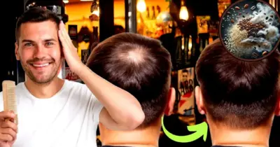Fim da calvície em homens: Receitinha caseira com café +2 ingredientes traz melhor implante capilar caseiro