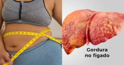 Suga a gordura no fígado: 3 truques populares regula o colesterol e elimina pesadelo das 45+