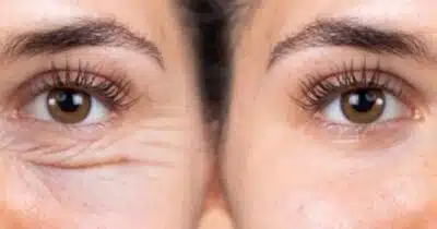 Creme clareia ao redor dos olhos e combate olheiras (Foto: Internet)