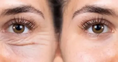 Xô rugas, olheiras e bolsas: Creme com 2 ingredientes clareia ao redor dos olhos e deixa pele lisinha
