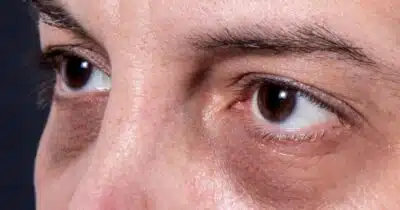 Manchas ao redor dos olhos sinalizam condição perigosíssima de saúde - Foto: Internet