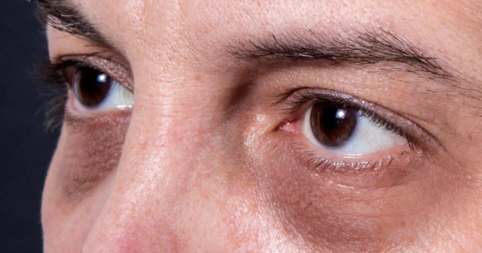 Manchas ao redor dos olhos sinalizam condição perigosíssima de saúde - Foto: Internet