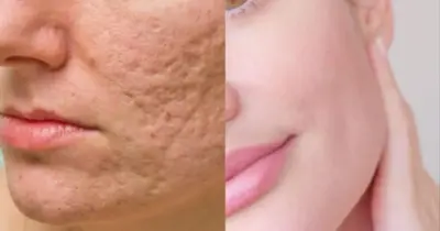 Pele lisinha para sempre: Receita com 4 ingredientes preenche poros abertos e remove manchas das mulheres 18+
