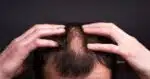 2 remédios naturais acabam com a queda de cabelo dos homens - (Foto: Internet)