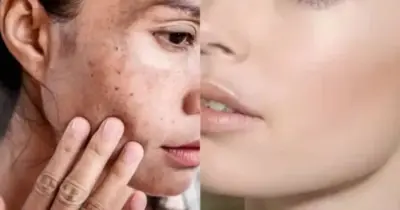 Milagre da juventude: Mistura natural com 2 ingredientes some com rugas e deixa pele lisinha igual ao botox