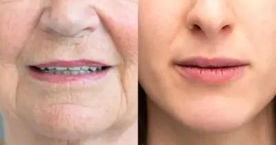 Tchau, Rugas: 4 ingredientes populares que são melhores que botox e esticam a pele em 3 dias