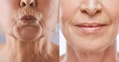 Melhor que preenchimento: Mistura natural com 3 ingredientes extermina rugas na boca em 20 minutos