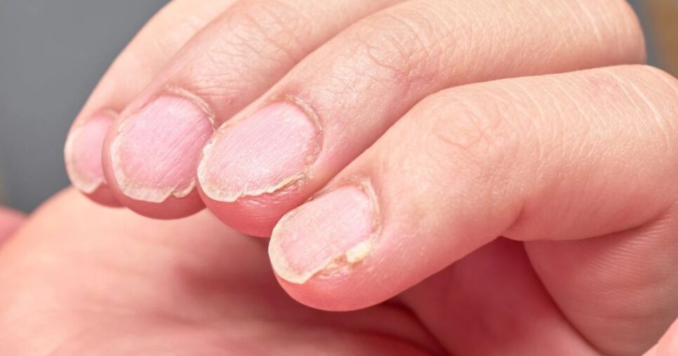 5 hábitos comuns triplicam a quebra das unhas - (Foto: Internet)