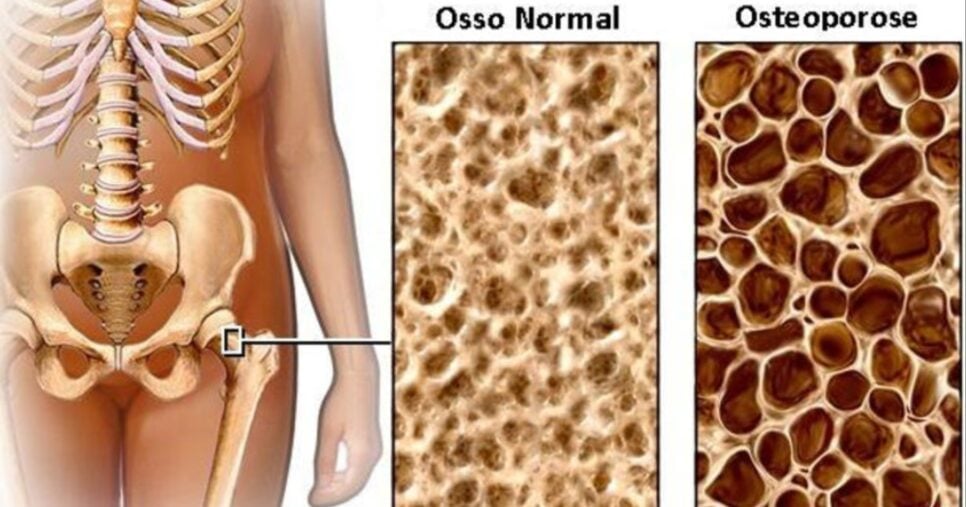 A osteoporose provoca a perda de massa óssea, tornando o osso mais frágil (Foto: Reprodução/ Internet)