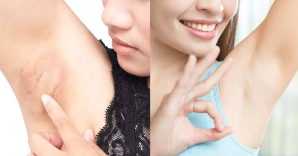 Misturinha com 3 ingredientes dá fim o CC e manchas nas axilas (Foto: Reprodução/ Internet)