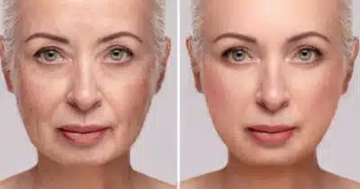 Mulher com e sem rugas (Foto: Freepik)