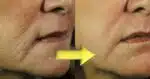 Pele com rugas - Montagem: TVFOCO