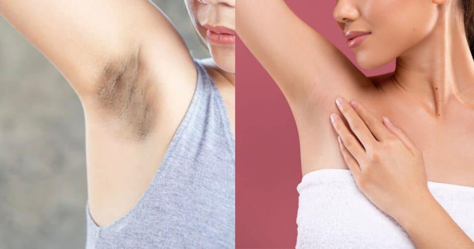 Mistura com 4 ingredientes remove manchas e deixa axilas lisinhas (Reprodução/Montagem TV Foco/Canva)