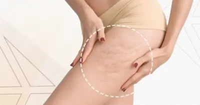 Drenagem linfática caseira: 2 bebidas populares eliminam celulite e te dar pernas dos sonhos