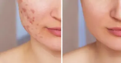 Fim do laser: 4 ingredientes acabam com qualquer cicatriz da pele em menos de 1 minuto