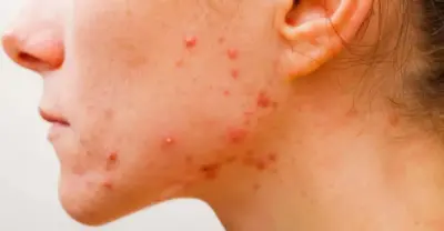 Chega de culpar o chocolate: Entenda por que a acne pode aparecer depois dos 25 anos