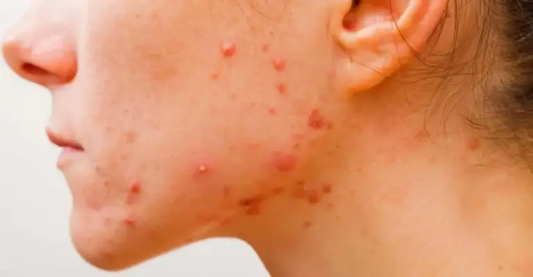 Chega de culpar o chocolate: Entenda por que a acne pode aparecer depois dos 25 anos Chega de culpar o chocolate: Entenda por que a acne pode aparecer depois dos 25 anos
