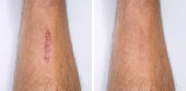 Antes e depois de cicatriz (Foto: Reprodução/ Internet) Antes e depois de cicatriz (Foto: Reprodução/ Internet)