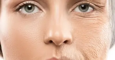 Botox natural: 4 óleos rejuvenescedores e naturais acabam com rugas e deixam pele jovem para sempre