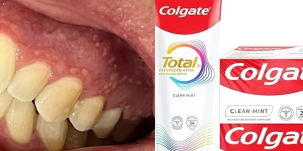 Denúncias alegam que a Colgate Total Prevenção Ativa causam lesões da região bucal (Foto Reprodução/Montagem/O Tempo)