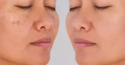 Adeus manchas do rosto: Receita fácil de 3 ingredientes caseiros produz o próprio colágeno e rejuvenesce
