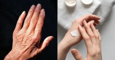 Mãos 30 anos mais jovem: Misturinha com 3 ingredientes dá fim aos calos em 5 minutos