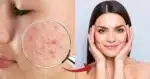 Mistura com leite e+ traz bomba de colágeno e fim da acne às 25+ (Foto: Reprodução/ Internet)