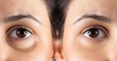 Dermatologistas escondem: 2 ingredientes populares clareiam olheiras e revivem o olhar em 5 minutos