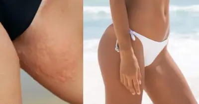 Fim do atrito nas coxas: 4 passos infalíveis acabam com irritação, coceira, feridas e até manchas no verão