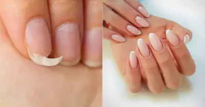 Falência das manicures: Mistura com 3 ingredientes fortalece, endurece e acelera o crescimento das unhas