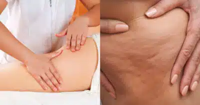 Drenagem linfática nas pernas para eliminar a celulite (Foto: Montagem)