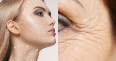 Lifting facial caseiro é possível com receita caseira (Foto: Montagem)