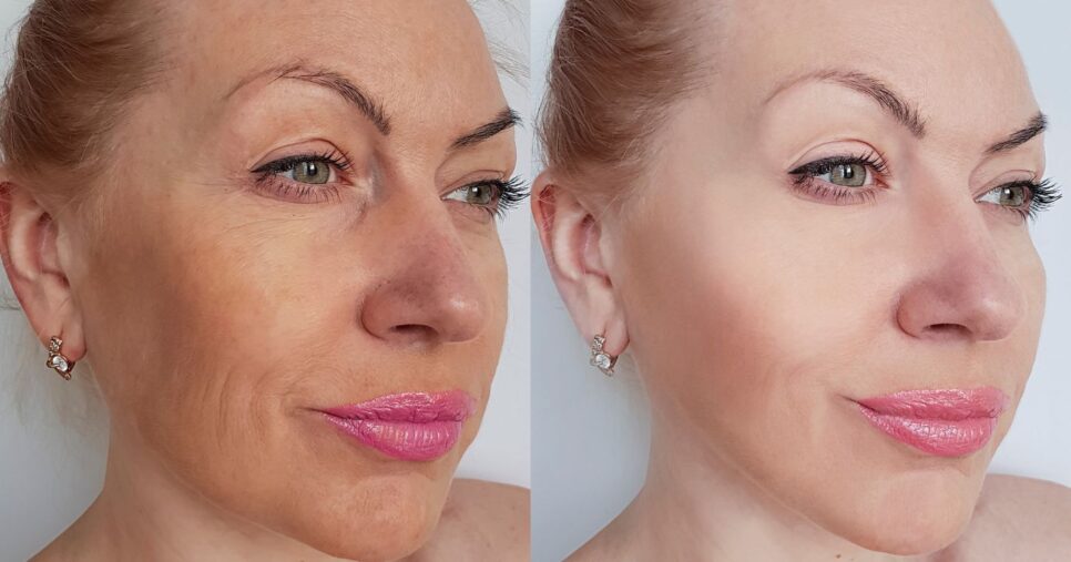 Ilustração antes e depois de rugas na pele (Foto: Canva)