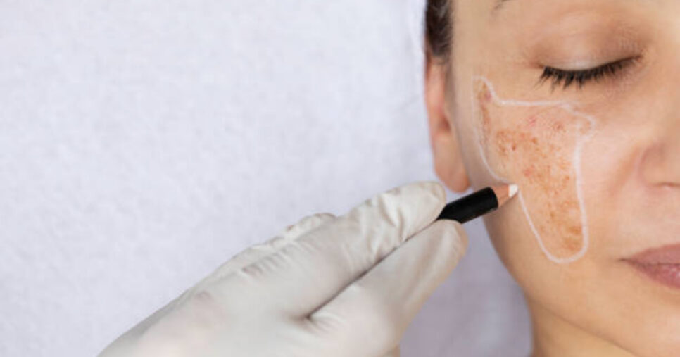 Melasma (Foto: Reprodução/iStock)
