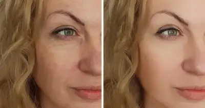 Fim da flacidez e rugas: Receitinha com só 2 ingredientes recupera o colágeno e rejuvenesce até 15 anos