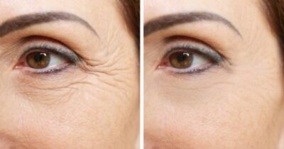 Creme natural arranca rugas de mulheres 40+ - (Foto: Internet)