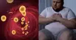 5 sintomas que indicam colesterol alto - Foto Reprodução Internet
