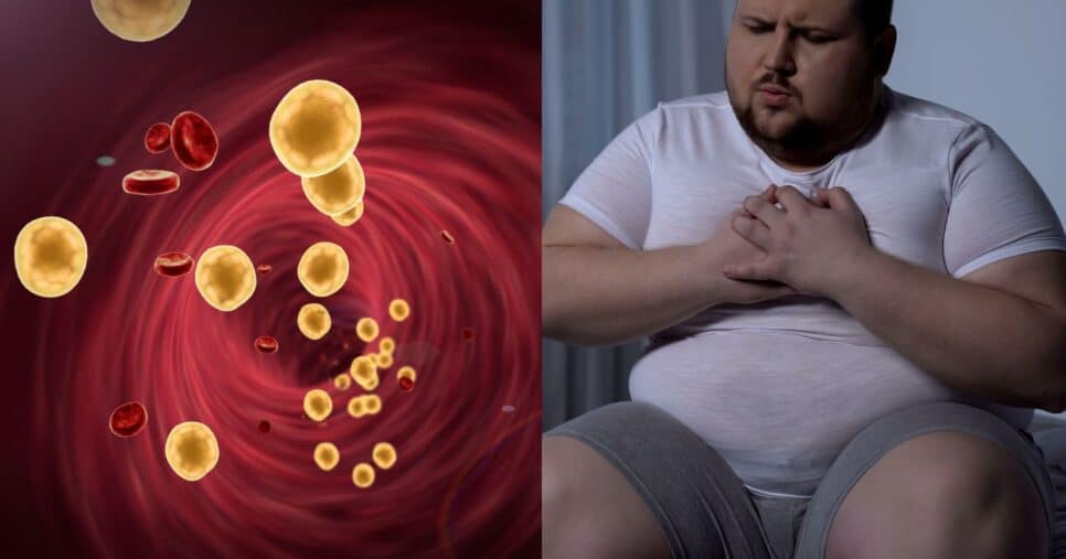 5 sintomas que indicam colesterol alto - Foto Reprodução Internet
