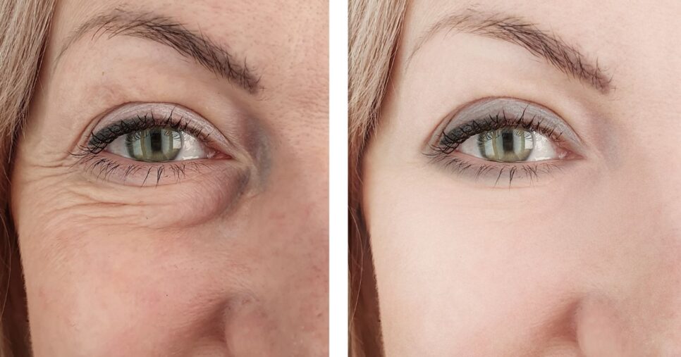 Antes e depois de rugas (Foto: Canva)