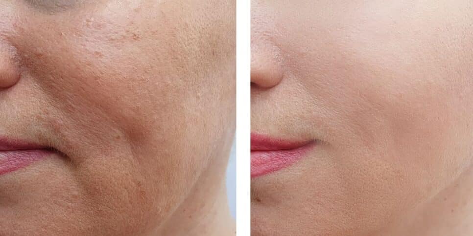 Antes e depois de rugas (Foto: Canva)